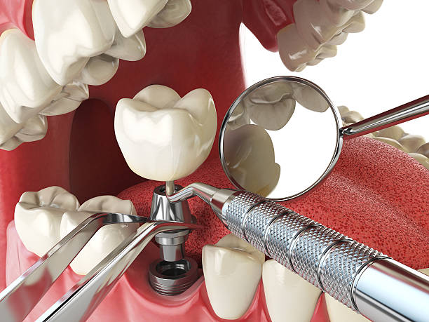 Best Emergency Dental Extractions in Parker, SC